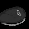 SPORK, NICO - 22.03.1976 - 02.08.2022 - CT obere Extremität - 18:02:23